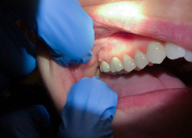 Best Emergency Tooth Extraction in Sachse, TX