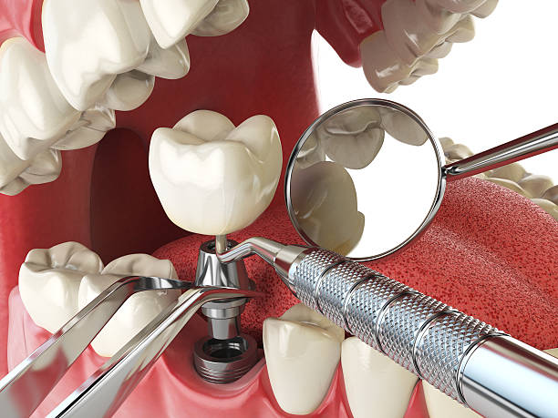 Best Emergency Wisdom Teeth Removal in Sachse, TX