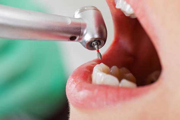 Best Emergency Gum Treatment in Sachse, TX